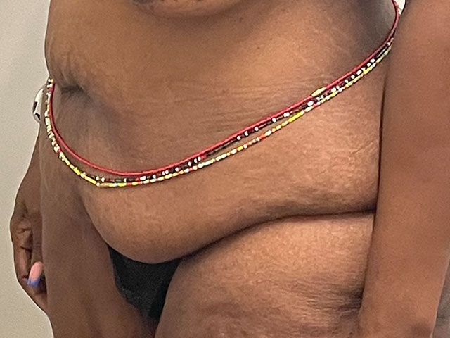 Abdominoplasty Before & After