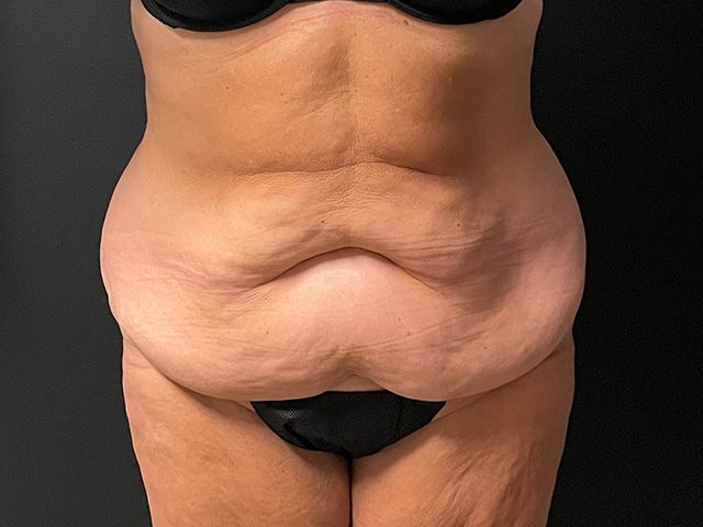Abdominoplasty Before & After