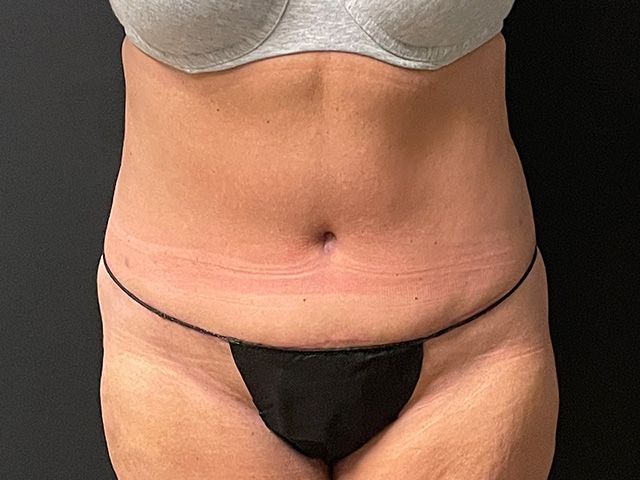 Abdominoplasty Before & After