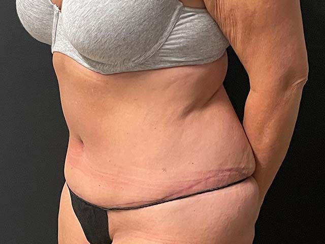 Abdominoplasty Before & After