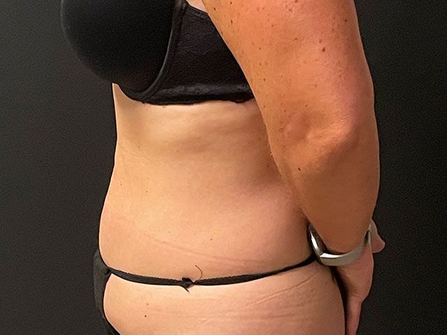 Abdominoplasty Before & After