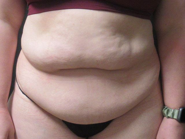 Abdominoplasty Before & After