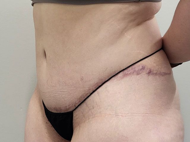 Abdominoplasty Before & After