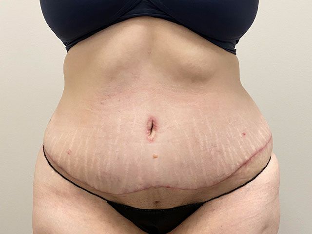 Abdominoplasty Before & After