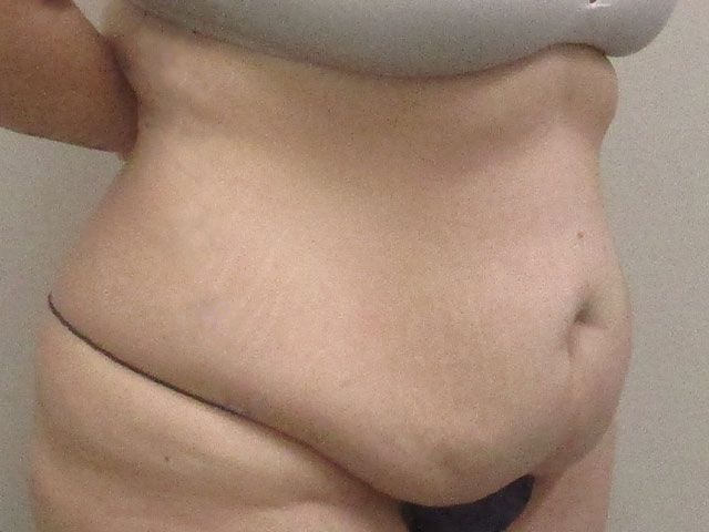 Abdominoplasty Before & After