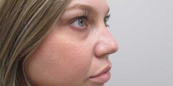 Under Eye Before & After