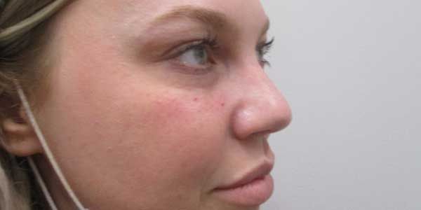 Under Eye Before & After