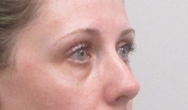 Under Eye Before & After