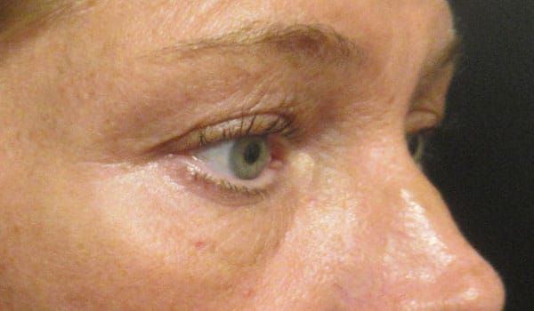 Under Eye Before & After