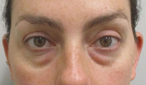 Under Eye Before & After