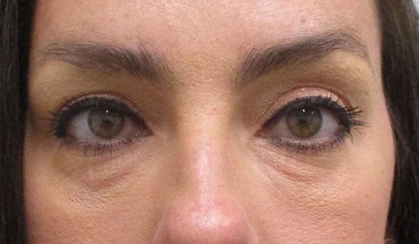 Under Eye Before & After