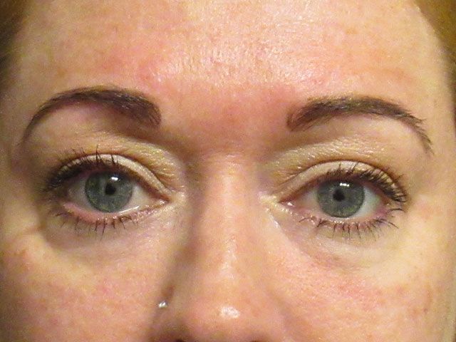 Under Eye Before & After