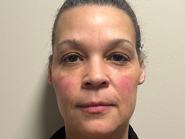 Under Eye Before & After