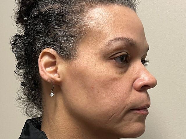 Under Eye Before & After