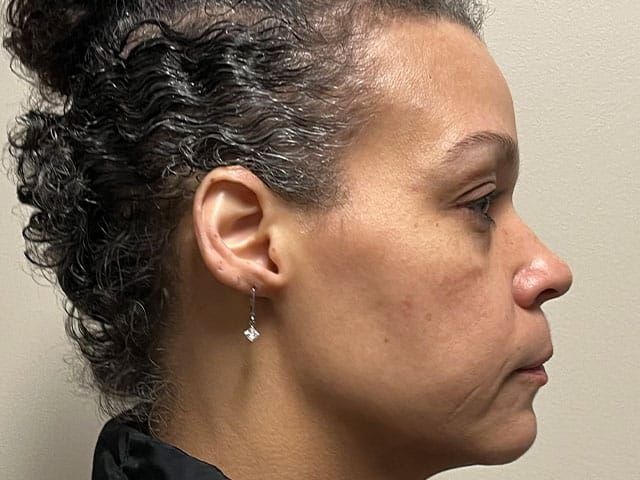 Under Eye Before & After