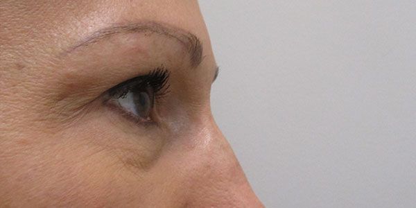 Under Eye Before & After