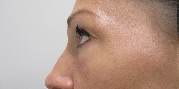 Under Eye Before & After