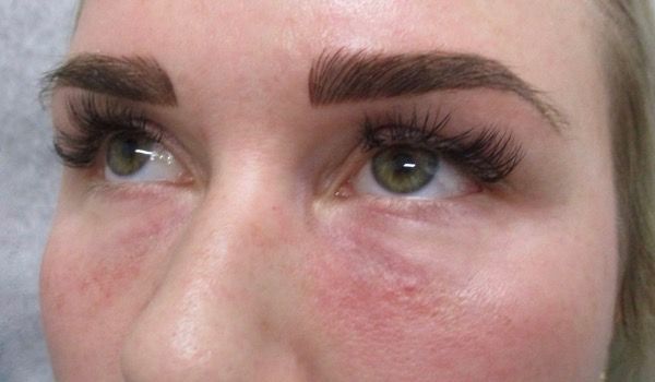 Under Eye Before & After