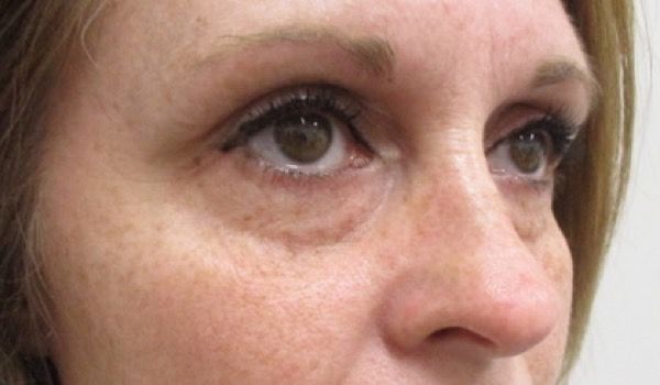 Under Eye Before & After