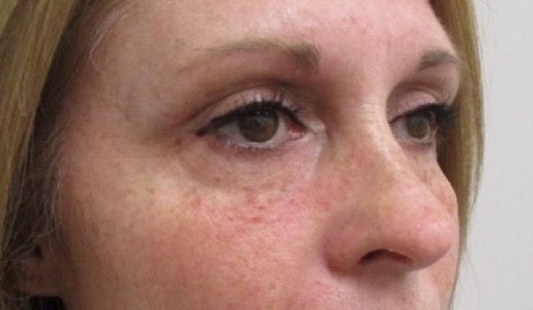 Under Eye Before & After