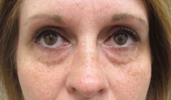 Under Eye Before & After