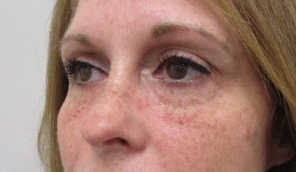 Under Eye Before & After