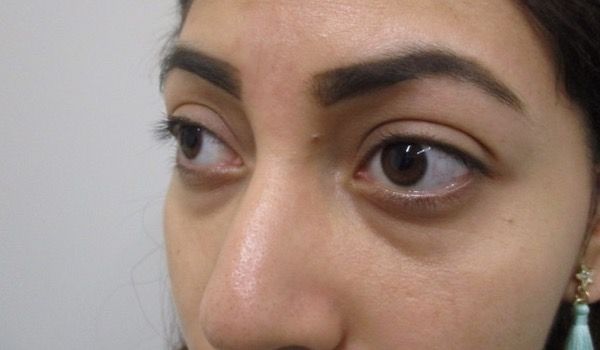 Under Eye Before & After