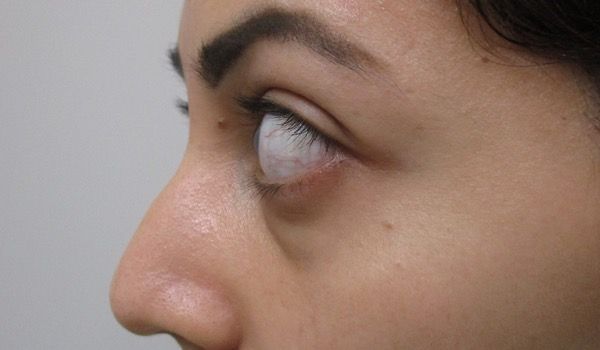 Under Eye Before & After