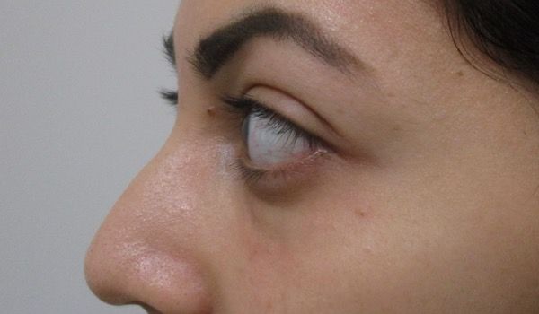 Under Eye Before & After