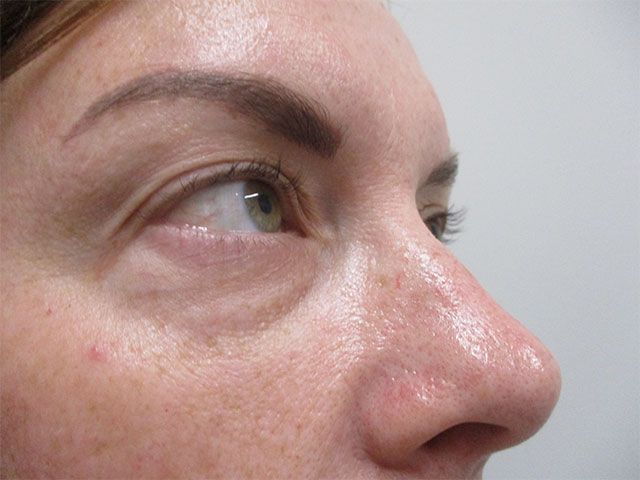 Under Eye Before & After