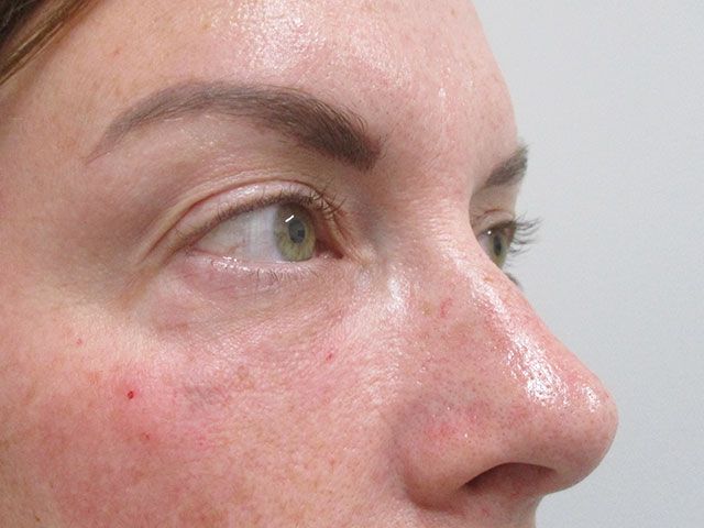 Under Eye Before & After