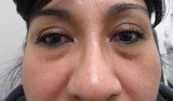 Under Eye Before & After