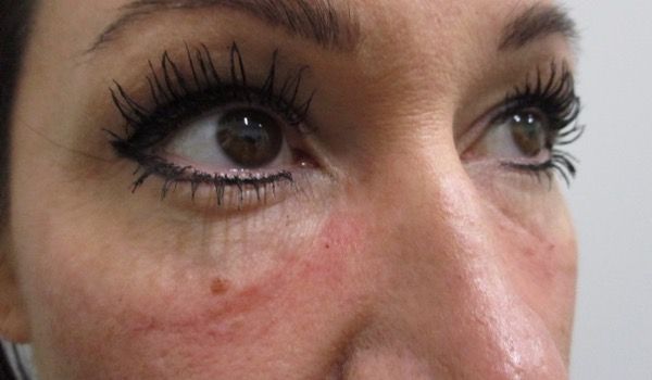 Under Eye Before & After