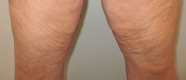 Morpheus8 Body Before & After