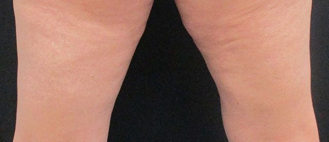 Morpheus8 Body Before & After