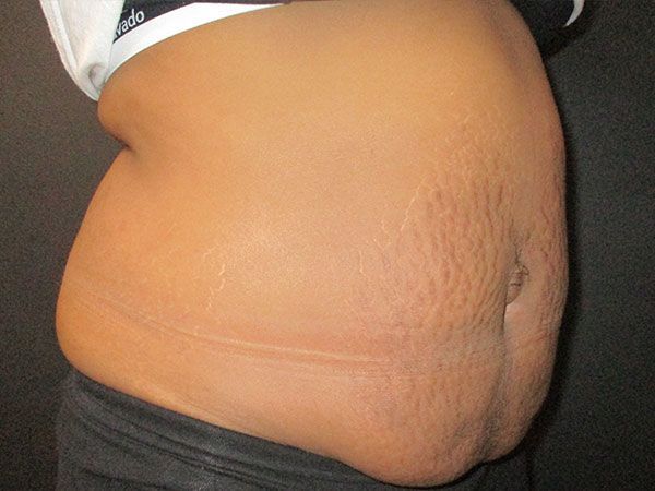 Morpheus8 Body Before & After