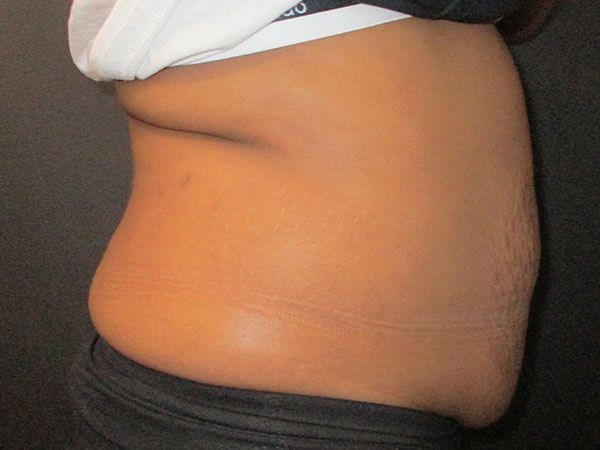 Morpheus8 Body Before & After