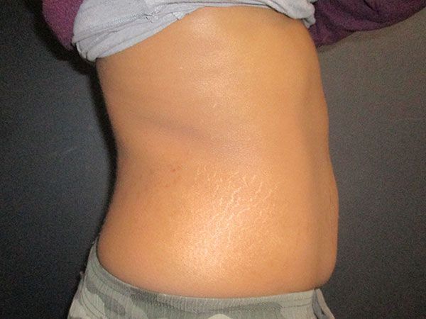 Morpheus8 Body Before & After