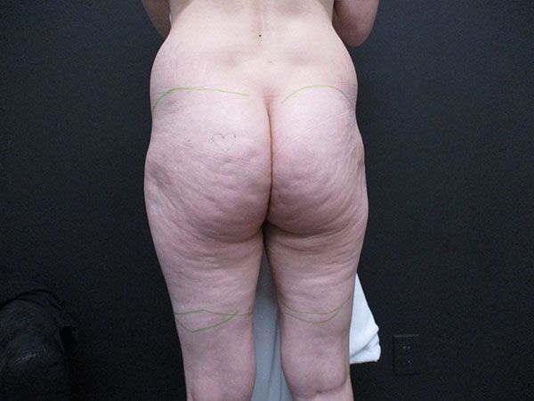 Morpheus8 Body Before & After