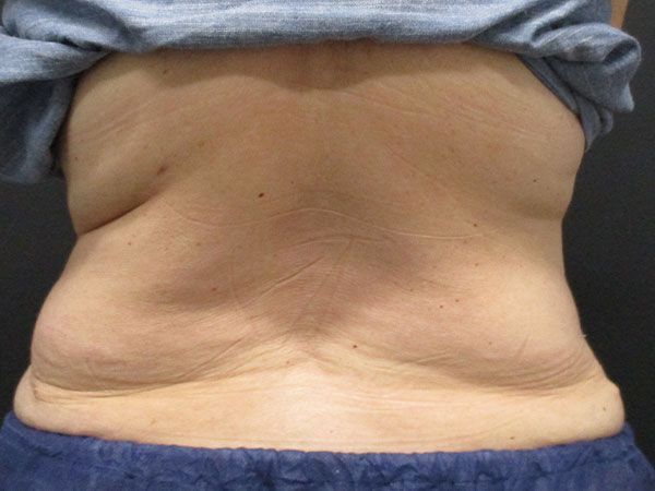 Morpheus8 Body Before & After