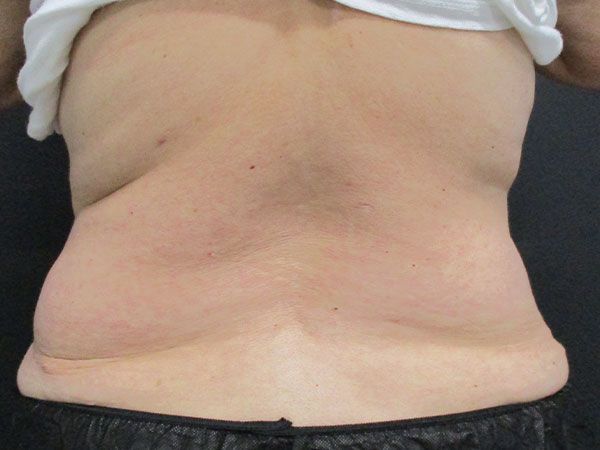 Morpheus8 Body Before & After