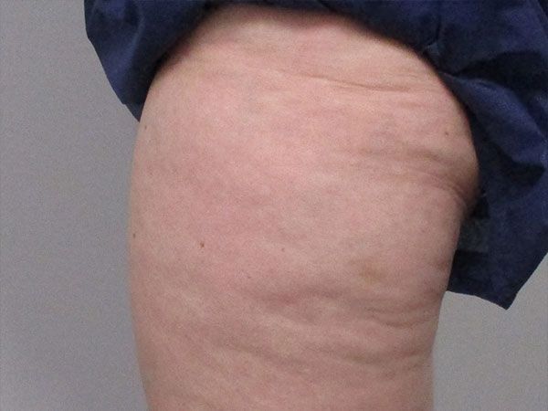 Morpheus8 Body Before & After