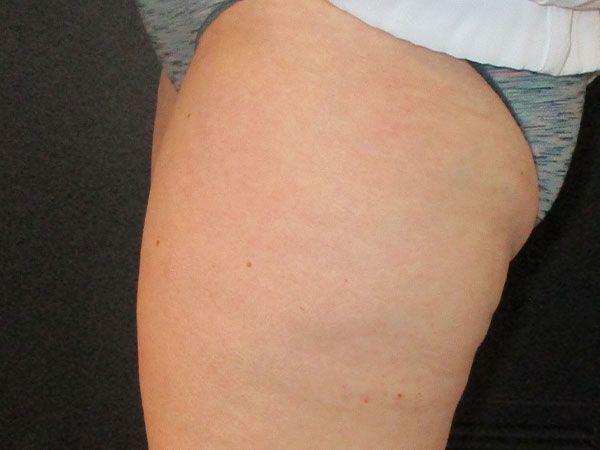 Morpheus8 Body Before & After