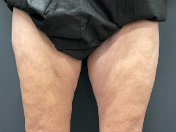 Morpheus8 Body Before & After