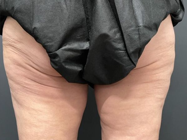 Morpheus8 Body Before & After