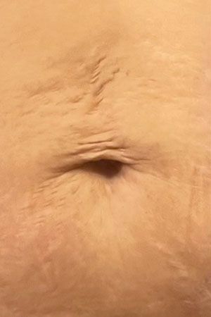 Morpheus8 Body Before & After