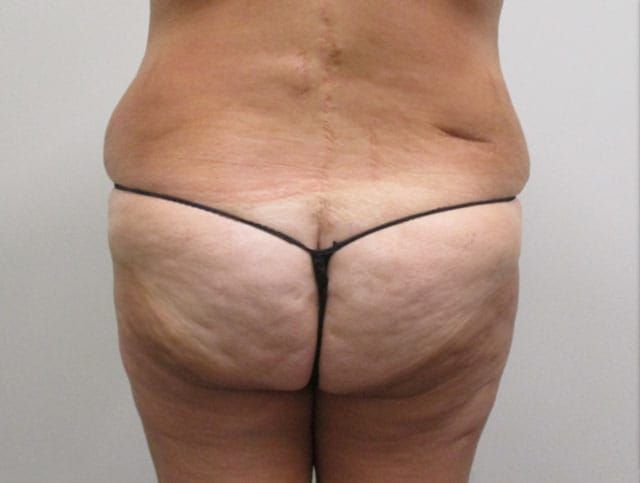 Liposuction Before & After