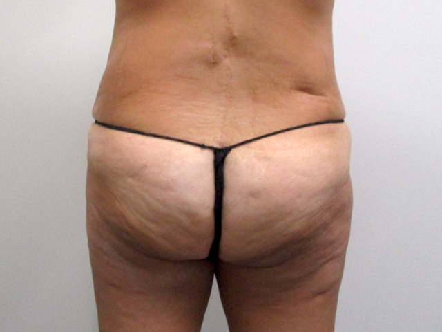 Liposuction Before & After