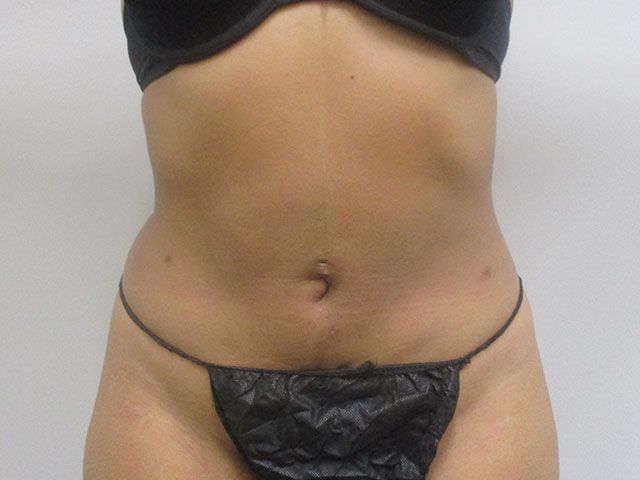 Liposuction Before & After