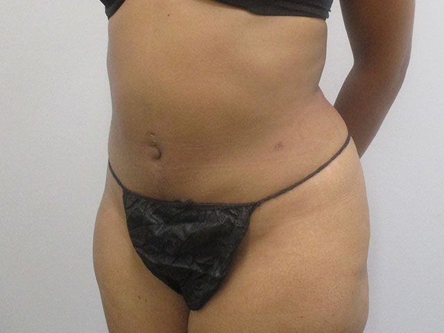 Liposuction Before & After